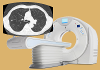 Ron Medical Lung cancer CT